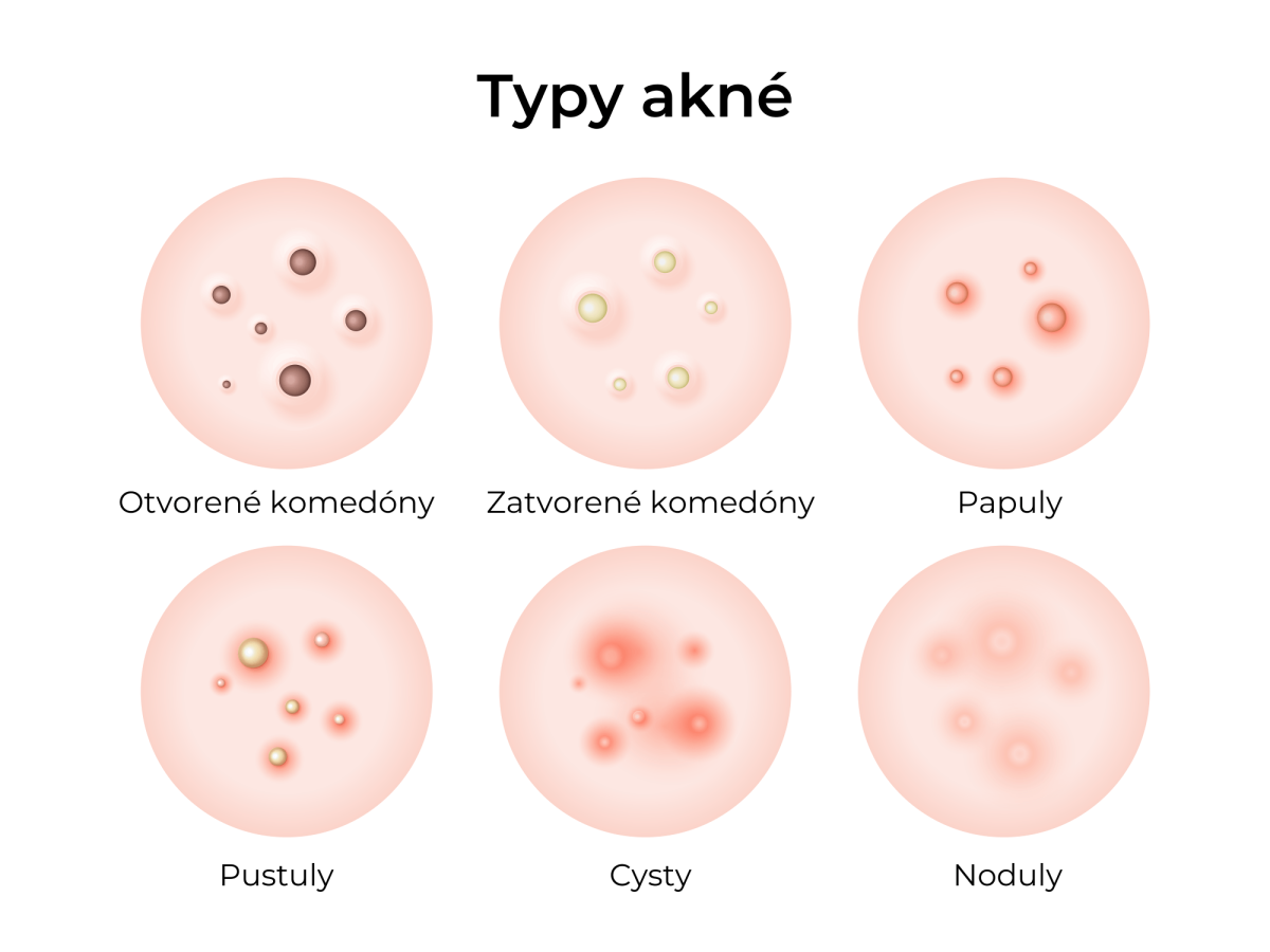 typy akné